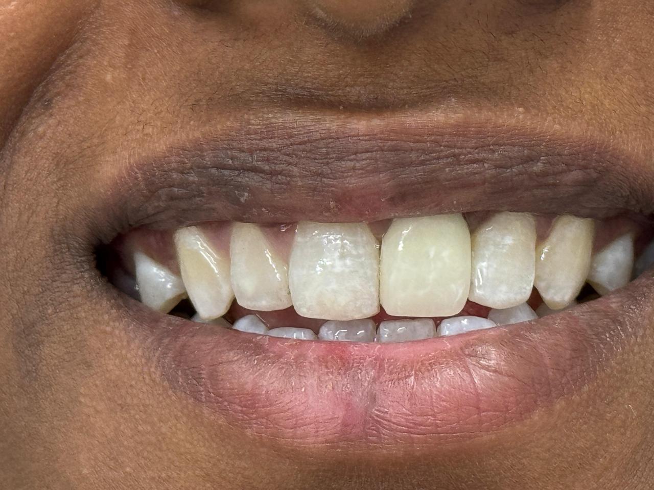 Improperly restored implant supported crown was redesigned after treatment